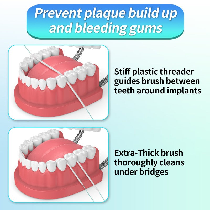 Easy-To-Use Sponge Floss for Bridge Crown Implants